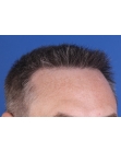 After Hair Transplant&nbsp;2 Sessions (Areas)